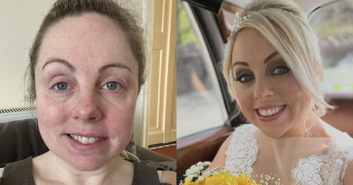 Charlie-Beswick-Bells-Palsy-face-drooping-wedding-disaster-facial-paralysis-2026-02-8ed0d01b11cd96fe51a71c77d80c9ee4-1200x630.jpg