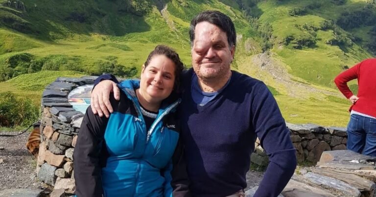 Rare disease took away one eye, people used to call him ‘creepy demon’, now this person made the world cry with his story!