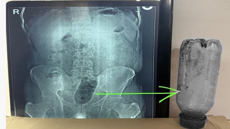 Bottle stuck in youth’s rectum: Endured unbearable pain for 36 hours, operation lasted 75 minutes; Know what the doctor said? – Bottle Lodged In Mans Rectum Surgery Brings Relief From Pain