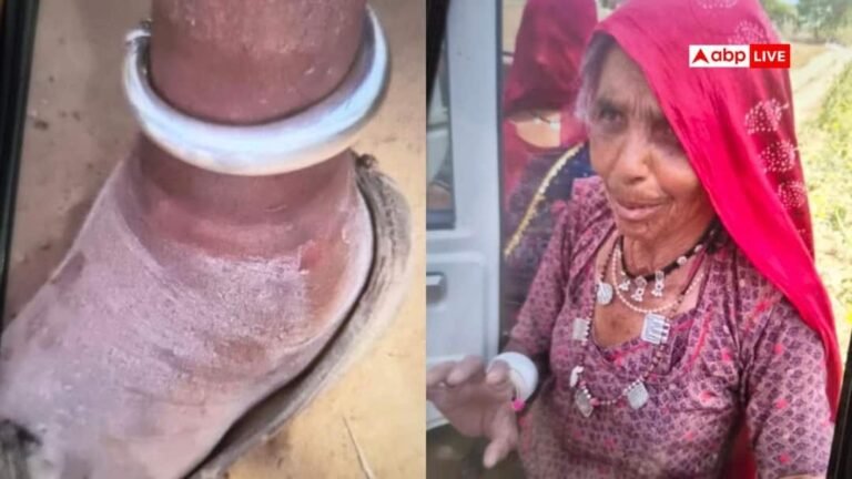 Big negligence of doctors in Jodhpur, surgery was done on the right leg of a 90 year old woman instead of her left one.